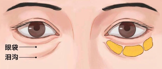 【去眼袋手术】眼袋自测：教你判断自己得眼袋膨出程度！