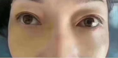 【去眼袋手术】眼袋自测：教你判断自己得眼袋膨出程度！
