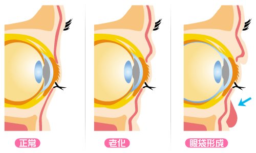 【去眼袋手术】眼袋自测：教你判断自己得眼袋膨出程度！