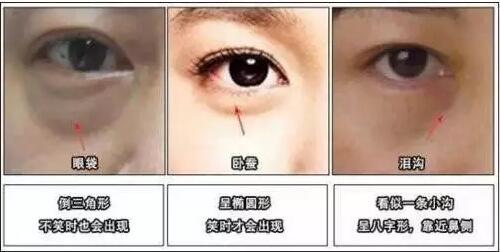 【去眼袋手术】眼袋自测：教你判断自己得眼袋膨出程度！