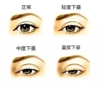 十一小长假怎么整？9命呀！做完双眼皮手术居然显老...