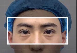 带男朋友ー起去做双眼 皮手术shì什么验？