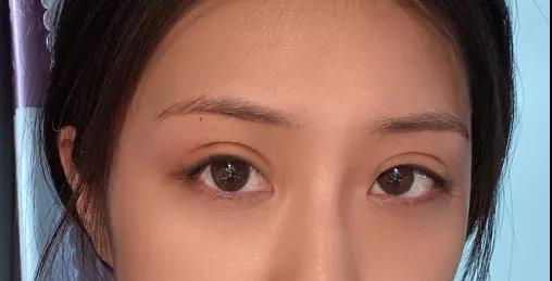 带男朋友ー起去做双眼 皮手术shì什么验？