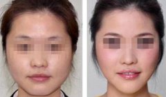 如何瘦脸891 如何瘦脸891